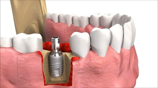   Ghép xương răng giúp hạn chế răng lung lay ê buốt
