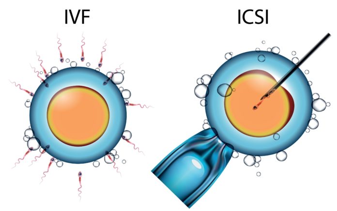 2 phương pháp hỗ trợ sinh sản IVF và ICSI