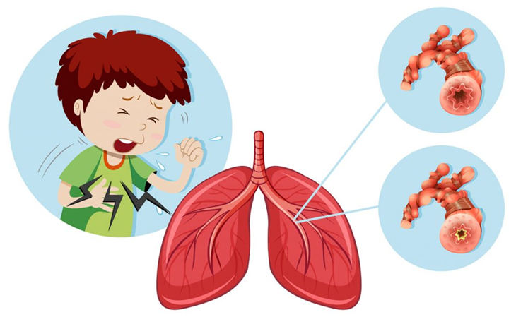   Viêm phế quản là tình trạng nhiễm trùng niêm mạc đường thở