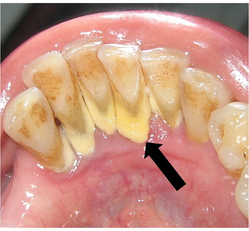   Mảng bám khiến tình trạng viêm quanh răng tiến triển