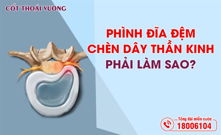 phinh-dia-dem-chen-day-than-kinh-phai-lam-sao