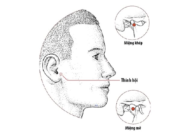 Bấm huyệt thính hội giúp chữa đau tai