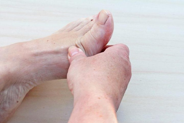 Bệnh gout gây đau đớn dữ dội tại khớp