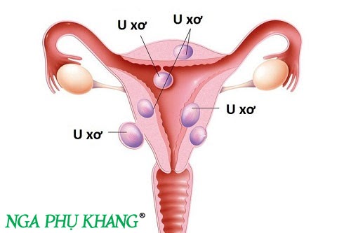 U xơ tử cung là bệnh phụ khoa phổ biến ở nữ giới trong độ tuổi sinh sản