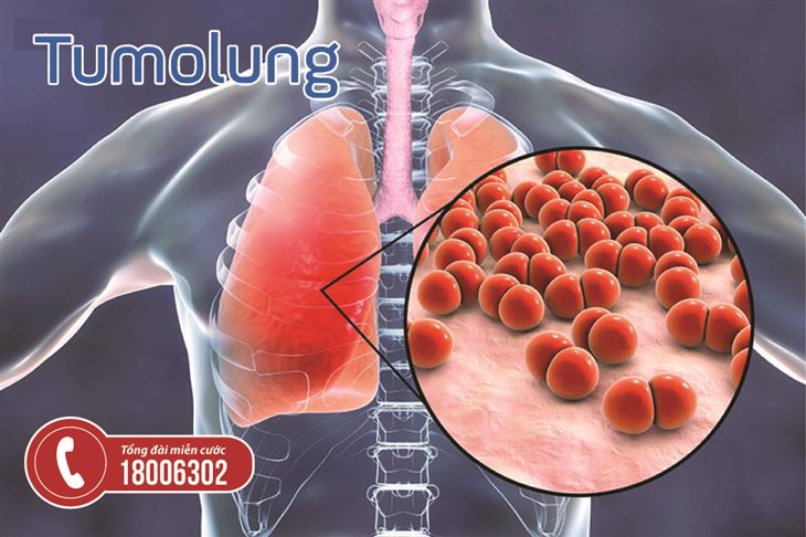 Bệnh lý u ở cuống phổi cần phát hiện và điều trị sớm