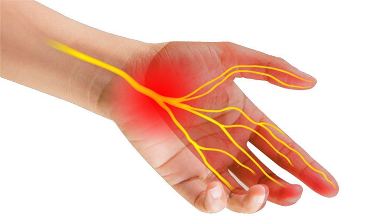 Hội chứng ống cổ tay gây cứng khớp ngón tay