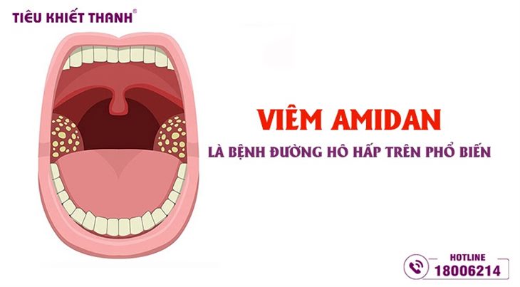 Viêm amidan là bệnh đường hô hấp trên phổ biến