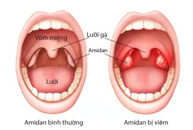 Viêm amidan gây đau rát họng, khản tiếng