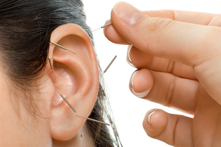 Nên cẩn trọng khi chữa ù tai bằng châm cứu