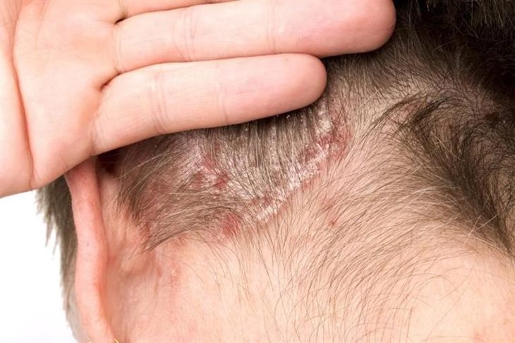Vảy nến da đầu là bệnh gì?