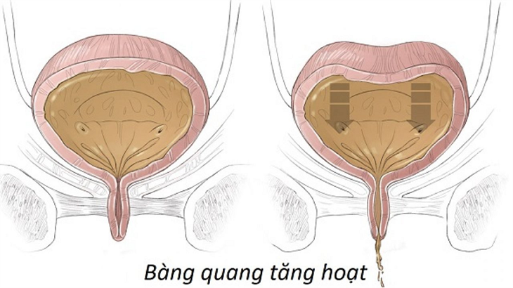   Bàng quang tăng hoạt gây tiểu đêm nhiều lần