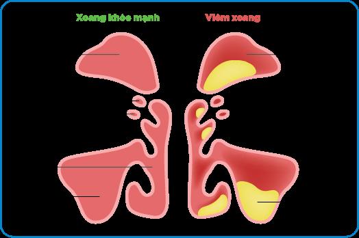    Ngứa cổ họng, ho là triệu chứng thường gặp khi bị viêm xoang