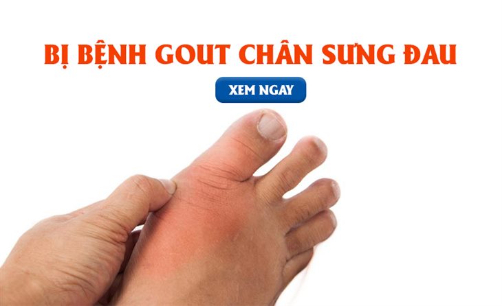 Bệnh gout thường gây sưng đau khớp chân