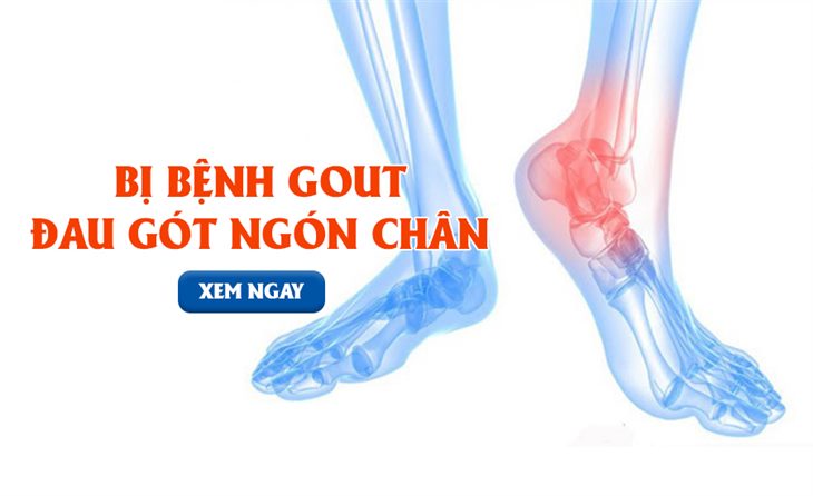 Bệnh gout gây đau ở gót chân