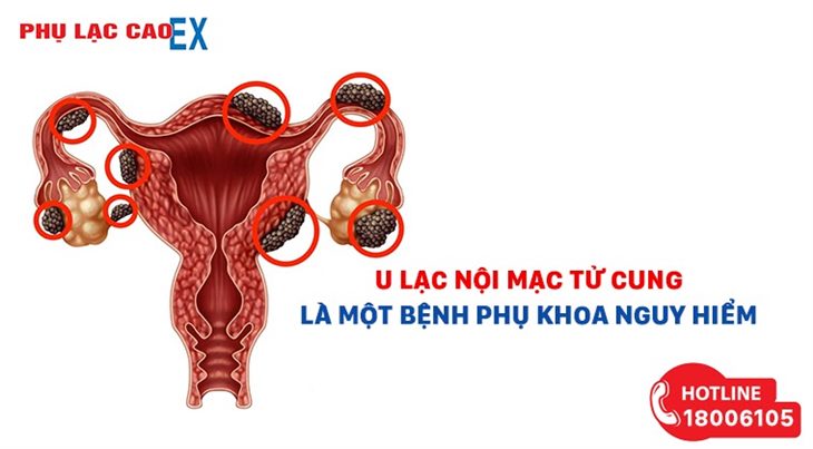U lạc nội mạc tử cung là một bệnh phụ khoa nguy hiểm
