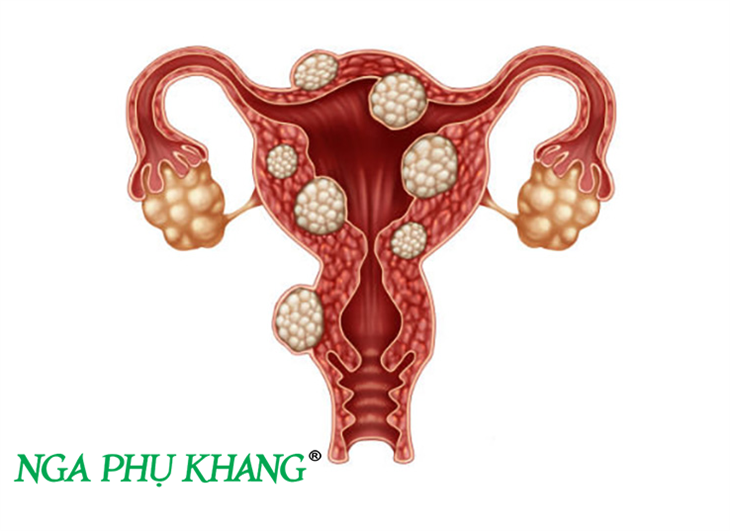 U xơ tử cung thường xuất hiện ở nữ giới trong độ tuổi sinh sản
