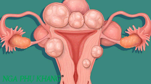 Phụ nữ mãn kinh vẫn có nguy cơ mắc u xơ tử cung