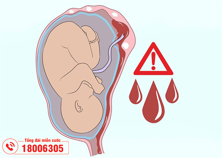 U xơ tử cung dễ gây sảy thai