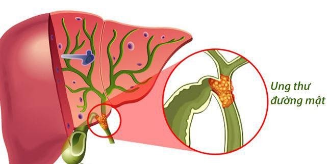 Ung thư đường mật ngoài gan là gì?