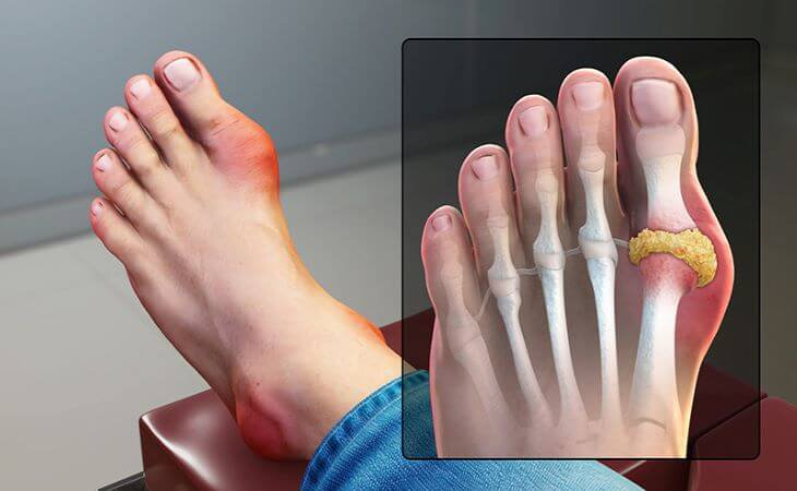 Ngón chân cái đau nhức, sưng tấy có thể là dấu hiệu của bệnh gout