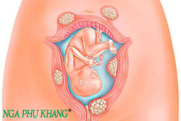 U xơ tử cung khi mang thai ảnh hưởng đến sự phát triển của bé