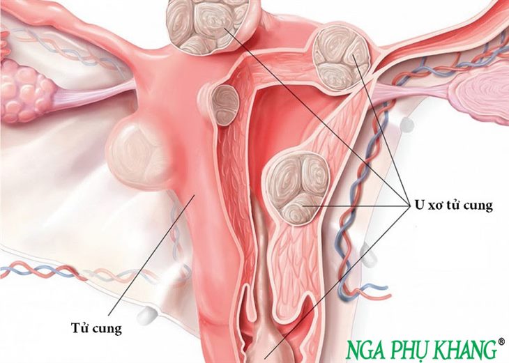 U xơ tử cung dễ xuất hiện ở phụ nữ trong độ tuổi sinh sản
