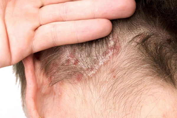 Da đầu bị tróc vảy là dấu hiệu của bệnh vảy nến