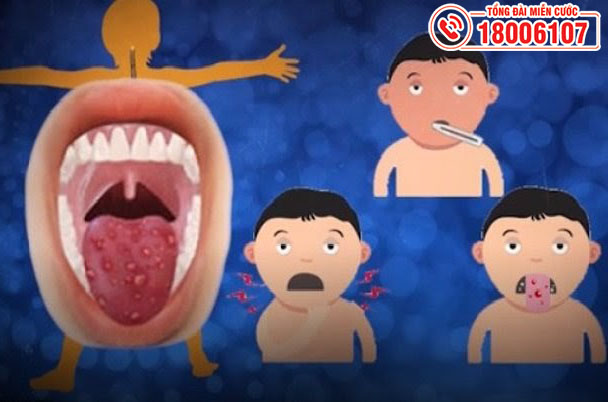  Loét miệng là một trong những triệu chứng của bệnh tay chân miệng