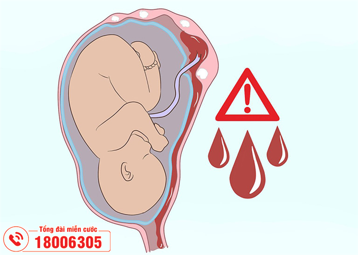 U xơ tử cung dễ làm sảy thai, sinh non