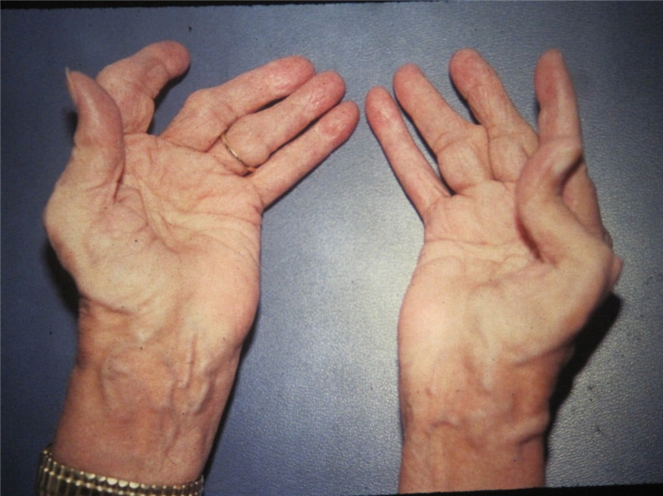 Viêm khớp dạng thấp khiến các khớp ngón tay bị biến dạng