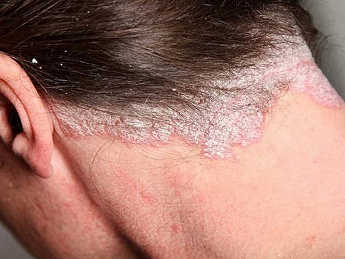 Dấu hiệu của bệnh vảy nến da đầu