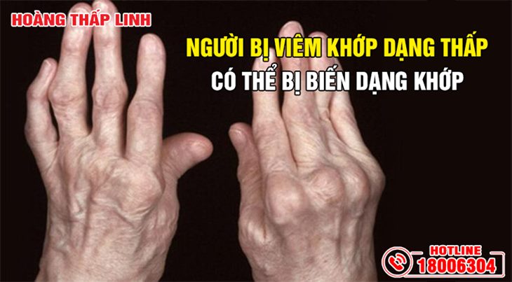 Bàn tay bị biến dạng khớp ở người bị viêm khớp dạng thấp