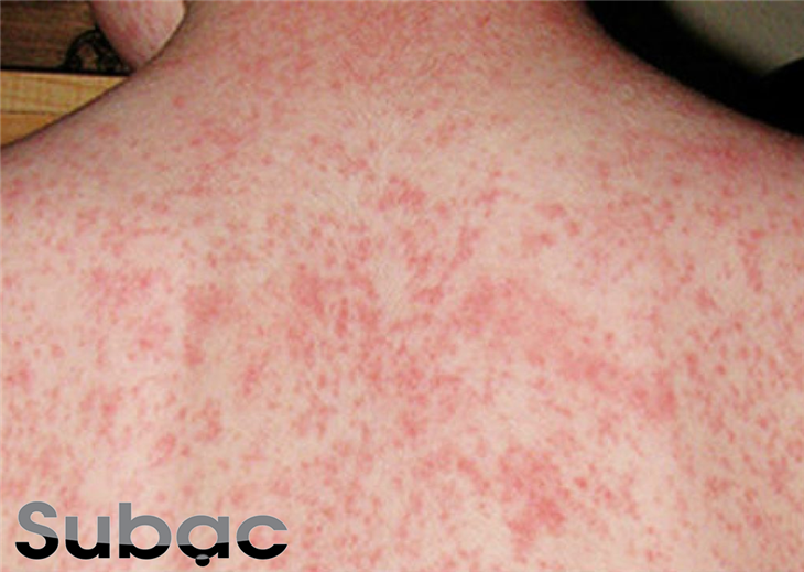 Xuất hiện ban đỏ là triệu chứng đặc trưng của bệnh sởi