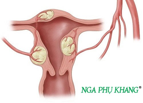 U xơ tử cung là bệnh phụ khoa phổ biến ở nữ giới trong độ tuổi sinh sản