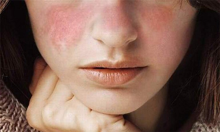   Dấu hiệu dễ nhận biết nhất của lupus ban đỏ là nổi ban ở hai bên má