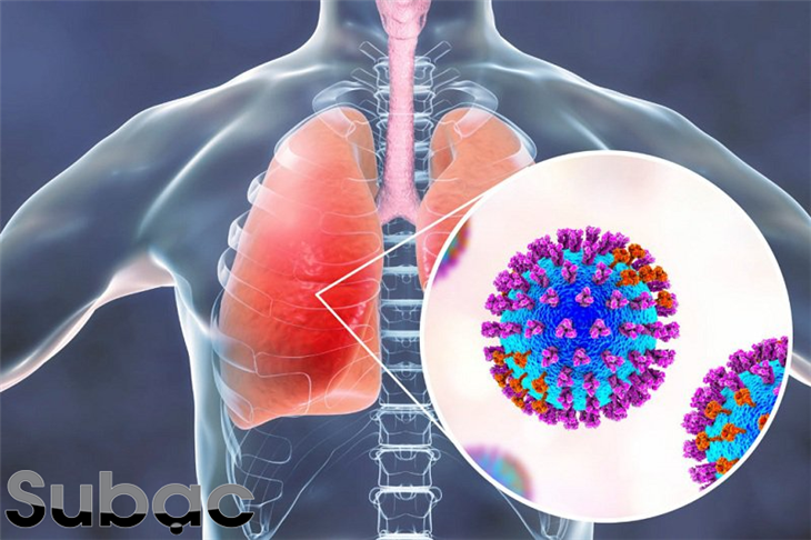 Bệnh sởi có thể gây biến chứng viêm phổi nặng