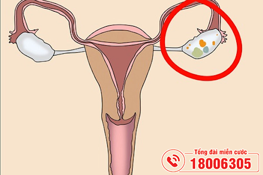 U nang buồng trứng xuất huyết có thể gây hoại tử buồng trứng