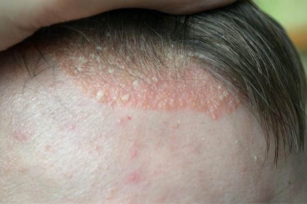 Triệu chứng bệnh vảy nến da đầu