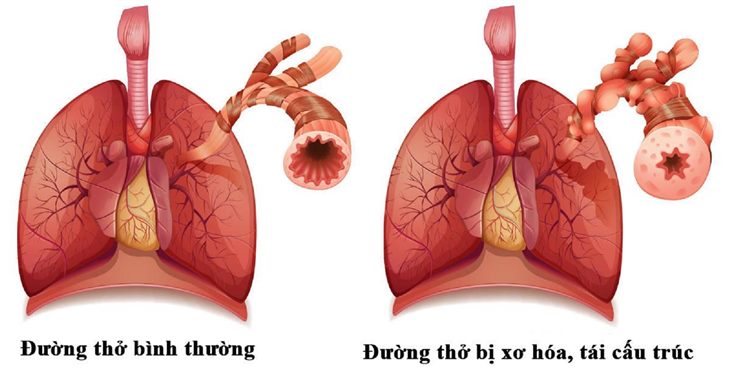   Tái cấu trúc đường thở là nguyên nhân gây ra các bệnh viêm đường hô hấp