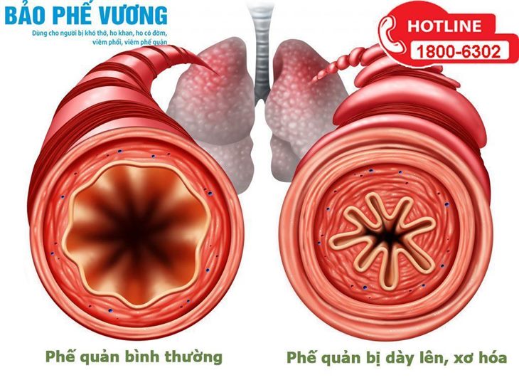   Tái cấu trúc đường thở là nguyên nhân cốt lõi gây hen suyễn, bệnh phổi mạn tính