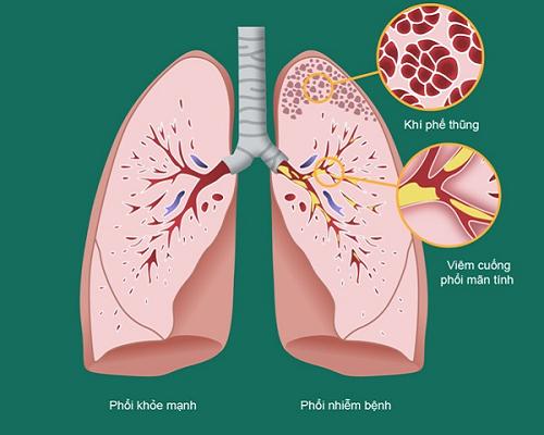   Tái cấu trúc đường thở là nguyên nhân cốt lõi gây viêm phổi