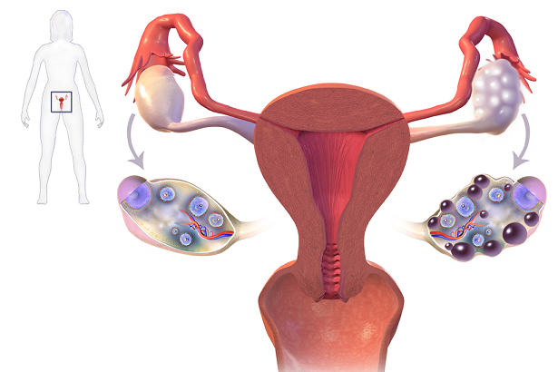Buồng trứng đa nang có thể gây vô sinh nữ