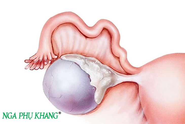 U nang bì buồng trứng bên trong chứa các mô tuyến bã, da, tóc, xương