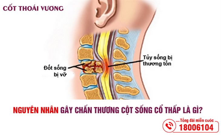 nguyen-nhan-gay-chan-thuong-cot-song-co-thap