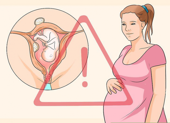  U nang buồng trứng có thể gây khó khăn trong sinh sản