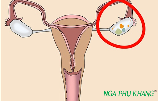 U nang buồng trứng thường gặp ở phụ nữ trong độ tuổi sinh sản