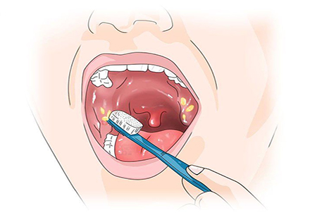 Vệ sinh răng miệng không đúng cách làm viêm amidan tái phát nhiều lần