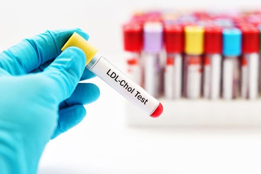 Xét nghiệm LDL -Cholesterol giúp đánh giá được tình trạng mỡ máu cao