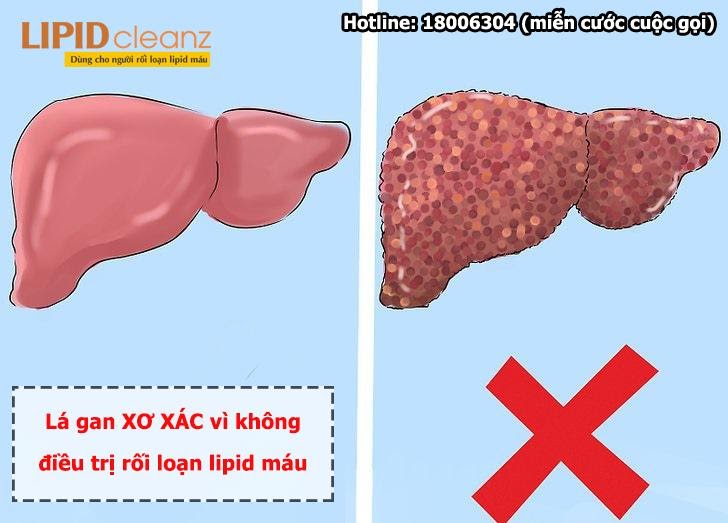 Lá gan xơ xác vì không điều trị tốt rối loạn lipid máu