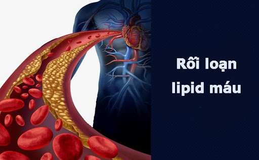 Rối loạn lipid máu là tình trạng phổ biến, tỷ lệ người mắc cao